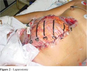 Image of an open abdominal wound with a wound vac