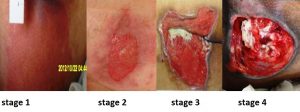 Image of pressure ulcer stage 1 through 4